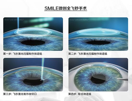 蔡司全飛秒、蔡司半飛秒近視手術(shù)與宇航飛秒的區(qū)別