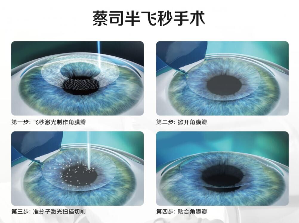 蔡司全飛秒、蔡司半飛秒近視手術(shù)與宇航飛秒的區(qū)別