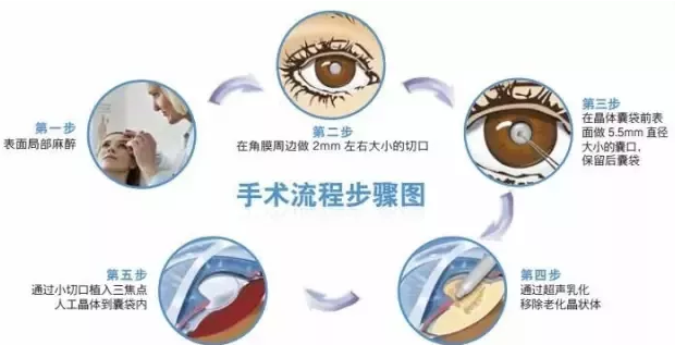 12月23日，普瑞眼科白內(nèi)障患者答謝會(huì)邀您參加!